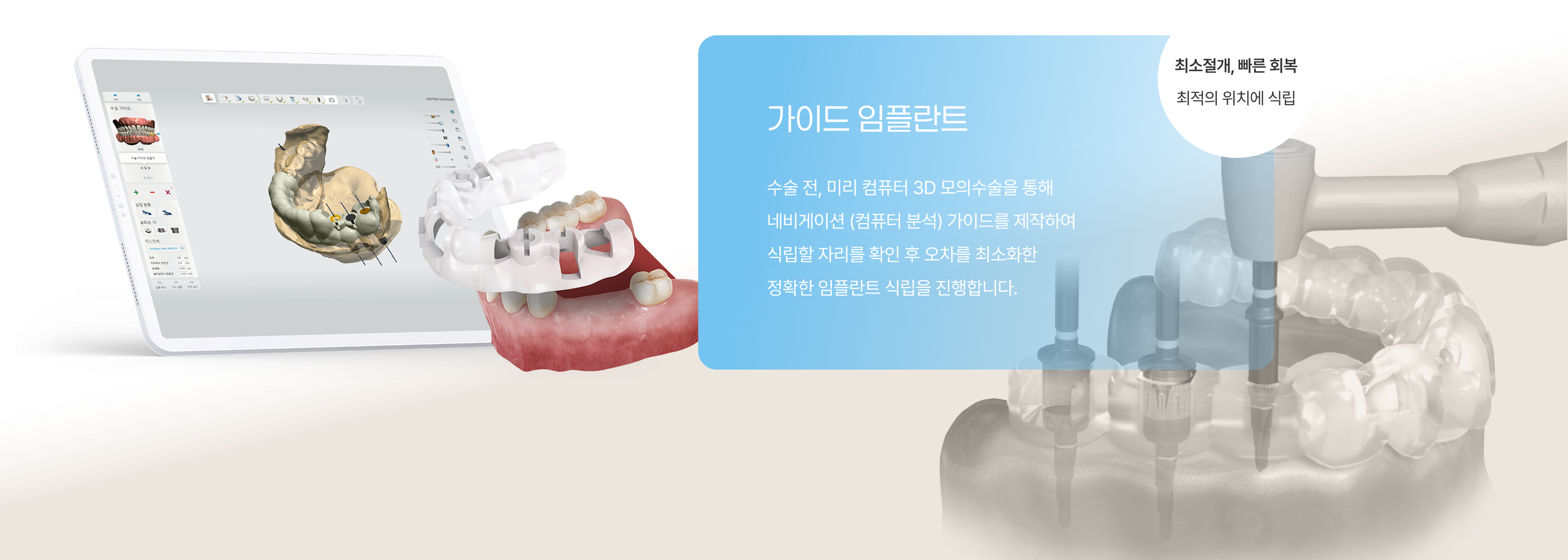 일반 임플란트 1