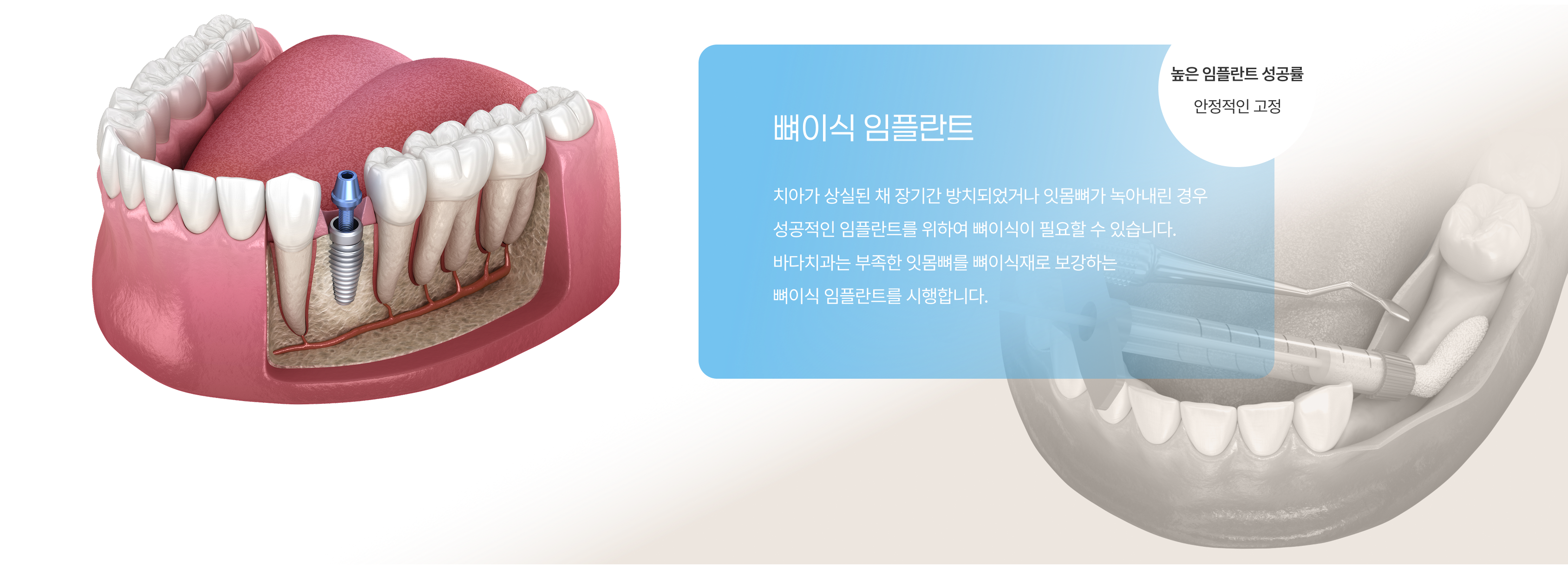 일반 임플란트 2