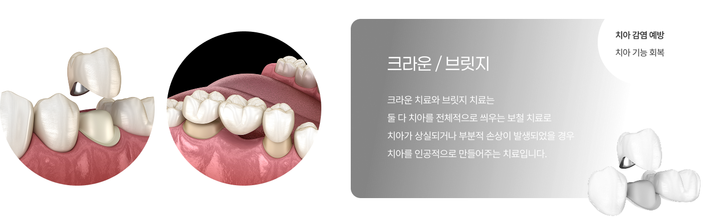 크라운 / 브릿지